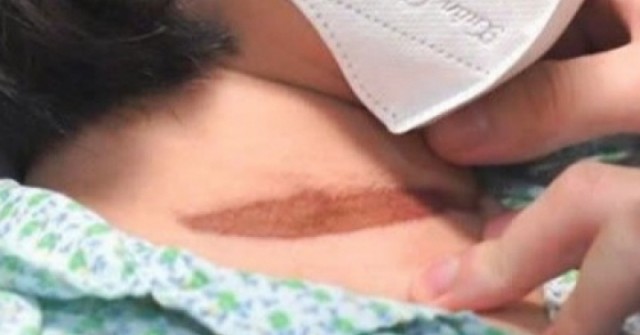 Bị cửa cuốn tại nhà kẹp cổ, bé gái 11 tuổi ngừng tuần hoàn, nguy kịch