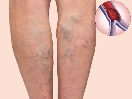 Suy giãn tĩnh mạch có thể gây nhiều biến chứng nghiêm trọng
