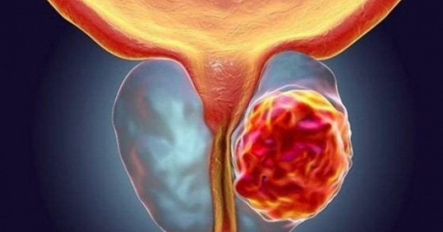 Ung thư tuyến tiền liệt di căn xương nguy hiểm thế nào?