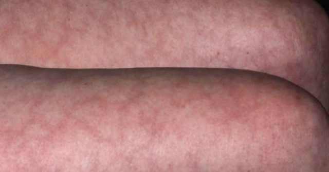 6 dấu hiệu mỡ máu cao thể hiện trên mặt và cơ thể