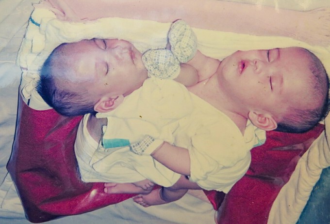 Song - Pha dính liền khi mới chào đời. Ảnh: Tư liệu