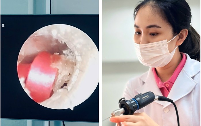 Dị vật là chun buộc tóc trong tai bé gái 6 tuổi. Ảnh: Lê Thanh