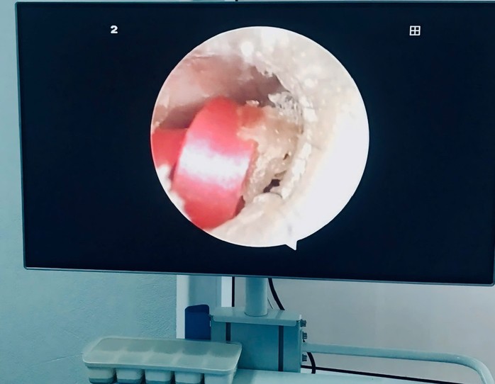 Hình ảnh dị vật nằm sâu trong tai bệnh nhân