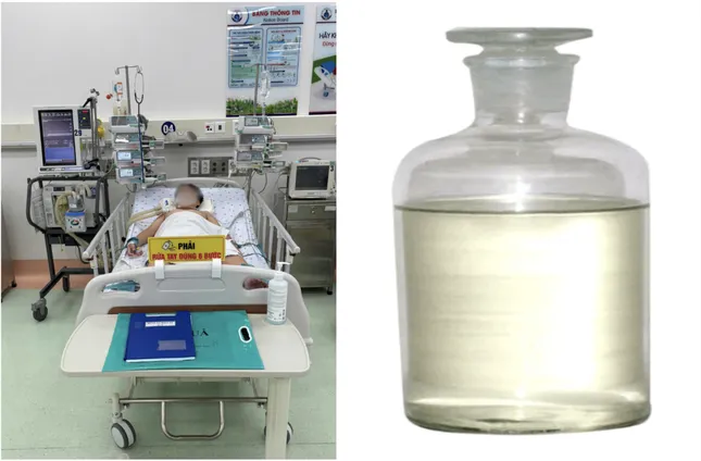 Chai hóa chất dùng để hàn nhựa có thành phần khí styrene đã khiến bé trai nguy kịch