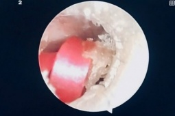 Bé gái suýt thủng màng nhĩ vì dị vật là sợi dây buộc tóc