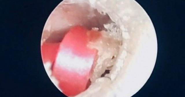 Bé gái suýt thủng màng nhĩ vì dị vật là sợi dây buộc tóc