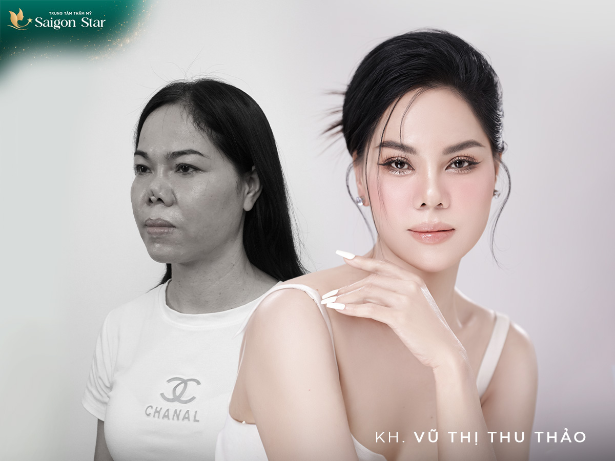 Chị Vũ Thị Thu Thảo – Sửa mũi hỏng chữa tâm hồn mùa 3