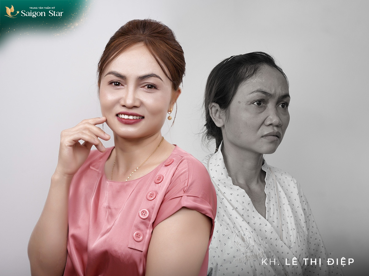 Chị Lê Thị Điệp – Sửa mũi hỏng chữa tâm hồn mùa 2