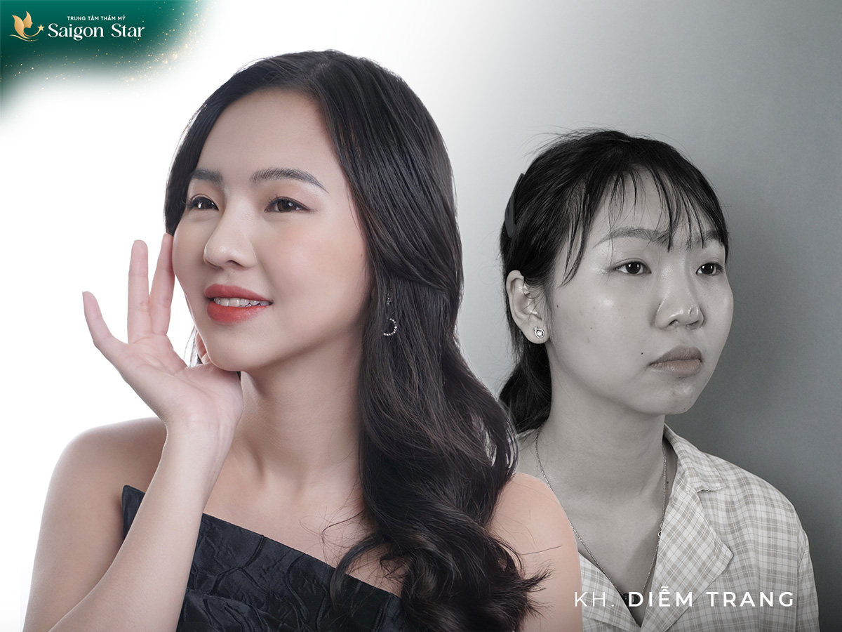 Diễm Trang – Sửa mũi hỏng chữa tâm hồn mùa 1