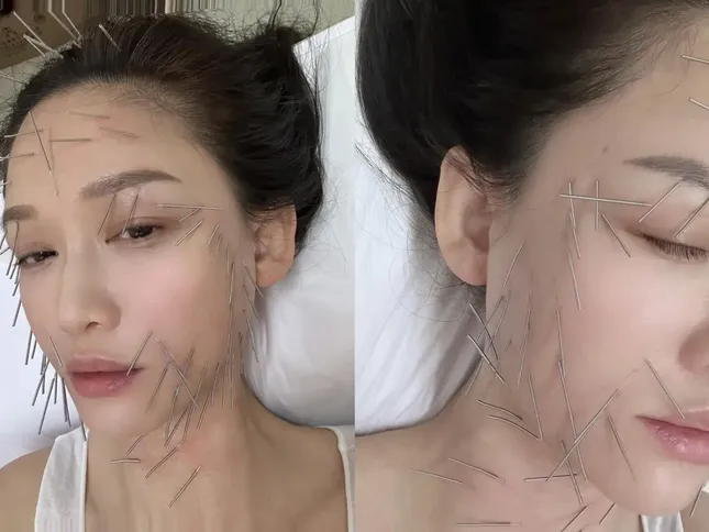 Trần Kiều Ân gây tranh cãi với phương pháp làm đẹp đau đớn