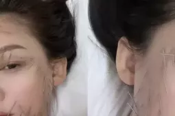 Trần Kiều Ân gây tranh cãi với phương pháp làm đẹp đau đớn