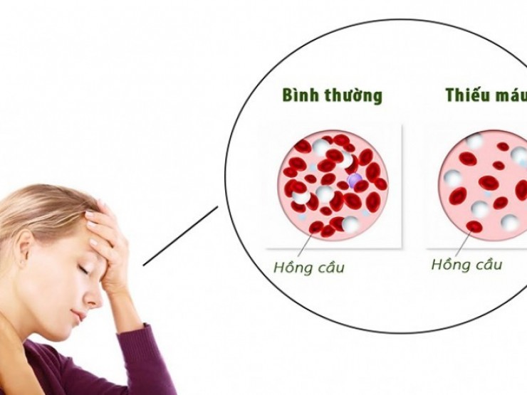 Bác sĩ Bệnh viện Bạch Mai chỉ rõ 6 dấu hiệu cảnh báo bệnh về máu