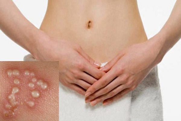 Quan hệ tình dục bằng miệng với bạn tình bị nhiễm bệnh có thể dẫn đến lây truyền bệnh Herpes.