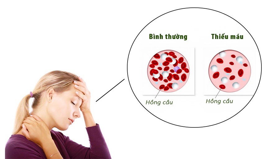 Bác sĩ Bệnh viện Bạch Mai chỉ rõ 6 dấu hiệu cảnh báo bệnh về máu - 1