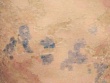Nam thanh niên 17 tuổi nhập viện do điều trị sởi sai cách, bác sĩ chỉ rõ sai lầm gây biến chứng nguy hiểm