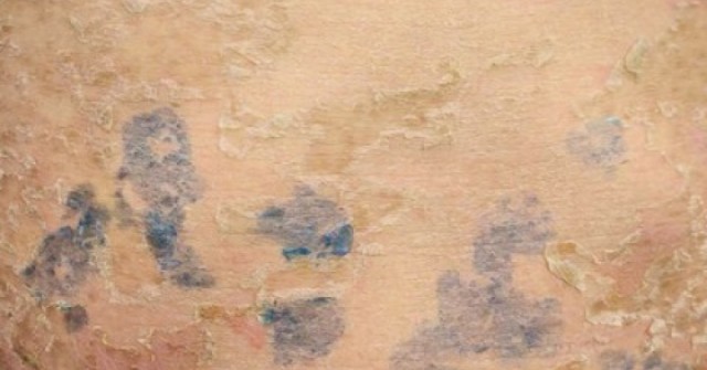 Nam thanh niên 17 tuổi nhập viện do điều trị sởi sai cách, bác sĩ chỉ rõ sai lầm gây biến chứng nguy hiểm