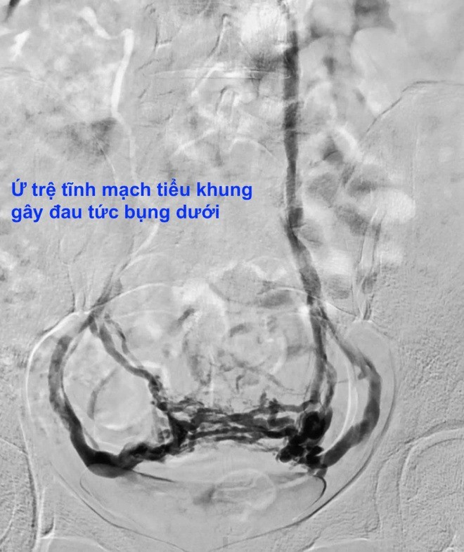 Đau bụng kéo dài hơn 10 năm, người phụ nữ phát hiện căn bệnh ít ai nghĩ tới - 1