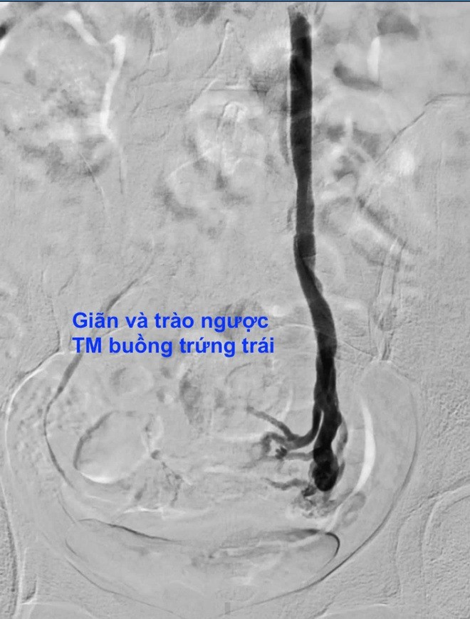 Các bác sĩ đã siêu âm bụng kết hợp với CT có tiêm thuốc cản quang để tìm ra nguyên nhân đau bụng hơn 10 năm qua cho bệnh nhân.