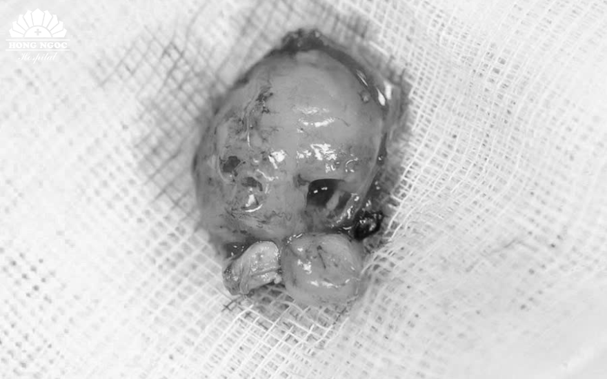 Bóc tách trọn vẹn khối u màng não kích thước 2cm