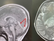 Bé 2,5 tuổi phát hiện bị đột quỵ từ dấu hiệu nhiều trẻ em Việt mắc phải