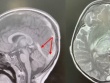 Bé 2,5 tuổi phát hiện bị đột quỵ từ dấu hiệu nhiều trẻ em Việt mắc phải