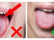Những dấu hiệu ở lưỡi cảnh báo vấn đề sức khỏe đáng lo ngại mà nhiều người bỏ qua