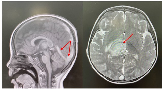 Hình ảnh huyết khối và tổn thương não trên phim MRI não của bệnh nhi. Ảnh: BVCC