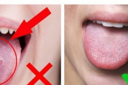 Những dấu hiệu ở lưỡi cảnh báo vấn đề sức khỏe đáng lo ngại mà nhiều người bỏ qua