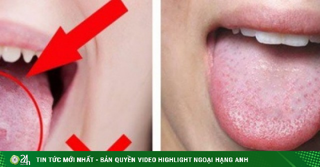 Báo Hiệu Nguy Hiểm Trên Lưỡi: 7 Dấu Hiệu Báo Tố Sức Khỏe Bạn Cần Biết!