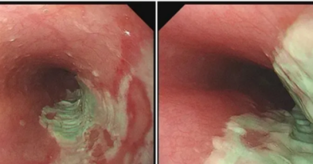 Người đàn ông 35 tuổi bị loét thực quản vì mắc sai lầm này khi uống thuốc
