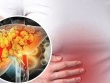 6 cách ngăn ngừa và kiểm soát bệnh gan nhiễm mỡ an toàn và hiệu quả