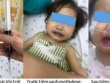 Bé 16 tháng tuổi nguy kịch sau bữa ăn trưa do mẹ nấu, bác sĩ chỉ rõ nguyên nhân