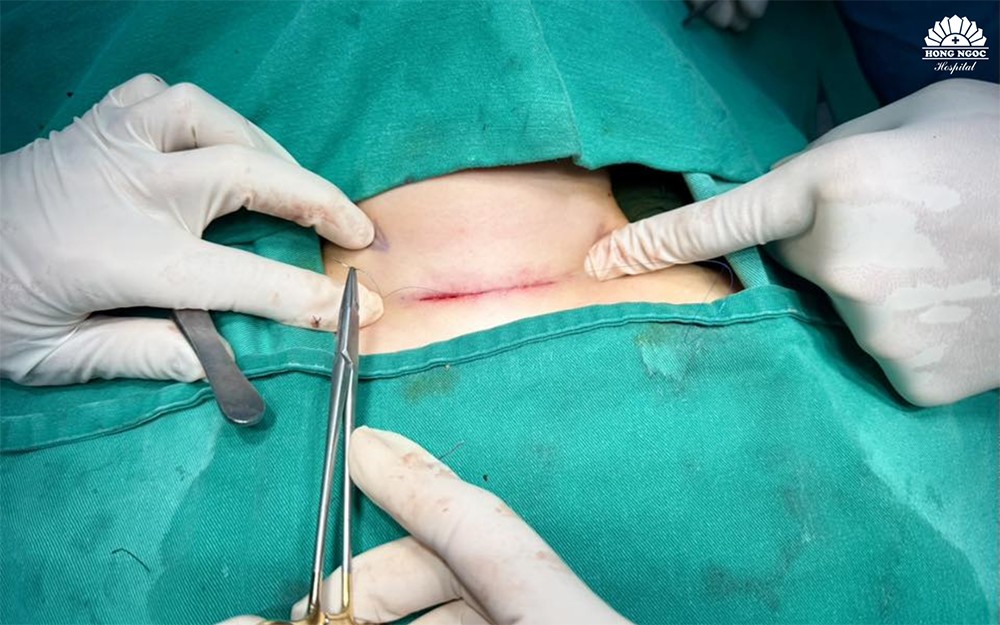 Đóng vết mổ lần lượt theo đúng lớp giải phẫu