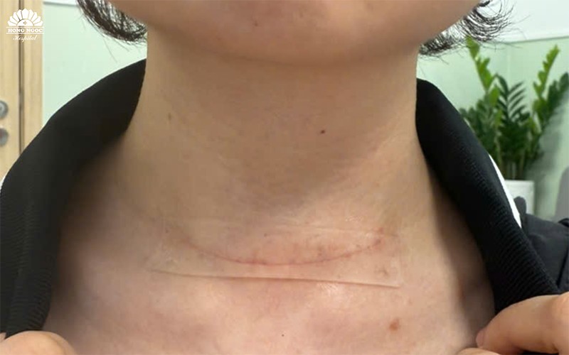Sẹo sau 2 tháng phẫu thuật Ung thư tuyến giáp của chị P