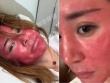 Mặt sưng đỏ, biến dạng sau 22 năm không tẩy trang