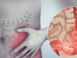 Người đàn ông 67 tuổi ở Hà Nội phát hiện ung thư đại tràng thừa nhận chủ quan với dấu hiệu báo bệnh này