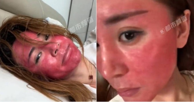 Người phụ nữ gây sốc với khuôn mặt biến dạng do thói quen không làm sạch da đúng cách.