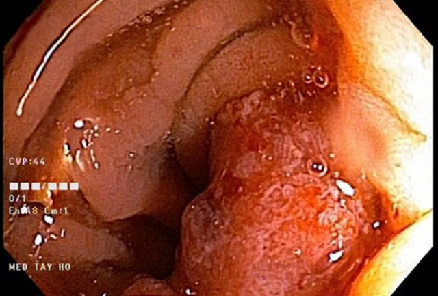 Ông T., nội soi đại tràng sigma có tổn thương sùi nham nhở, mủn nát. Ảnh: BVCC