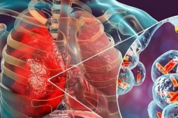 Bé 11 tuổi bất ngờ phát hiện ung thư phổi, nguyên nhân từ một sai lầm mà nhiều nam giới Việt mắc phải