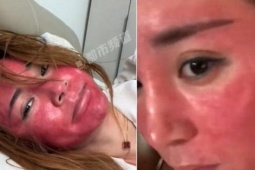 Mặt sưng đỏ, biến dạng sau 22 năm không tẩy trang