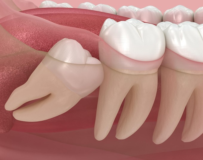 Mô phỏng răng khôn mọc lệch, đổ vào răng số 7. Ảnh: Royce Dental