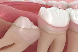 Vì sao một số người không mọc răng khôn?