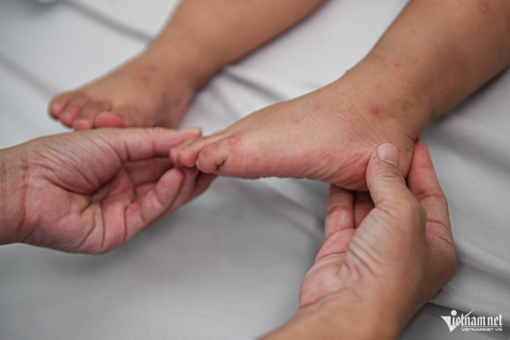 48 giờ mắc tay chân miệng, trẻ ngưng thở, lọc máu khẩn ở bệnh viện tuyến cuối - 8