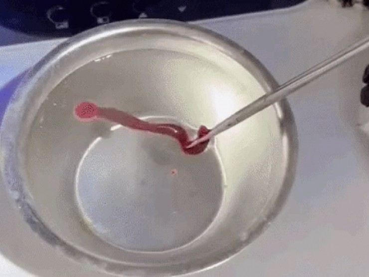 Rùng mình với dị vật "cố thủ" nhiều ngày trong mũi người đàn ông 38 tuổi