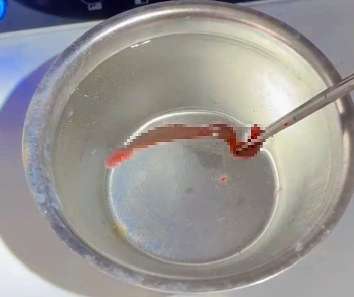 Dị vật là con đỉa sống được gắp ra khỏi mũi người đàn ông 38 tuổi