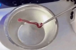 Rùng mình với dị vật "cố thủ" nhiều ngày trong mũi người đàn ông 38 tuổi