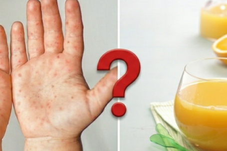 Nước cam tốt nhưng trẻ tay chân miệng nên tránh: Chuyên gia giải thích lý do