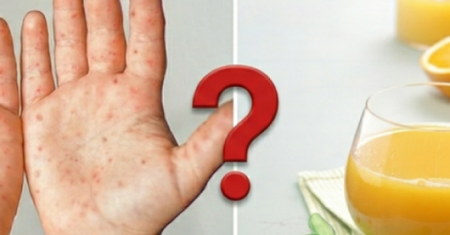 Nước cam tốt nhưng trẻ tay chân miệng nên tránh: Chuyên gia giải thích lý do