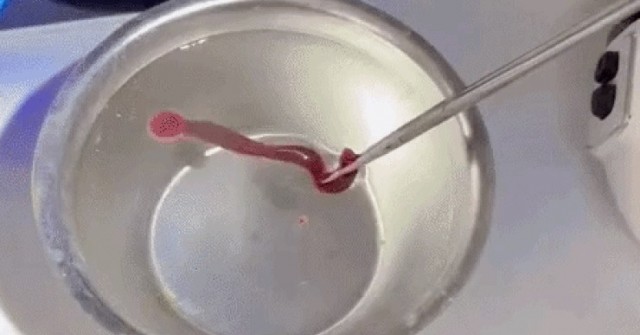 Rùng mình với dị vật "cố thủ" nhiều ngày trong mũi người đàn ông 38 tuổi