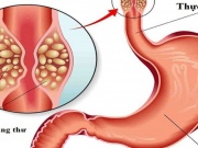 Người đàn ông 50 tuổi phát hiện ung thư dạ dày, tiền ung thư thực quản từ dấu hiệu nhiều người Việt bỏ qua